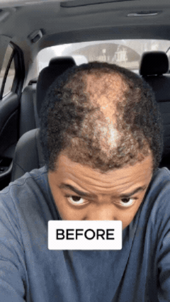 Before photo showing thinning crown hair loss