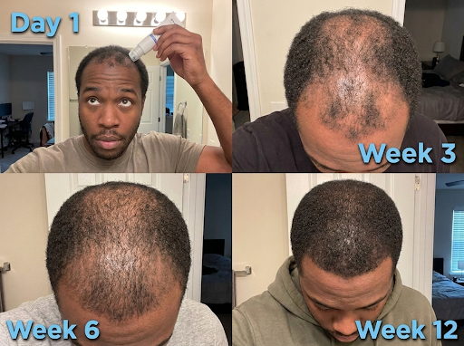 Progress photo grid showing hair regrowth over 12 weeks